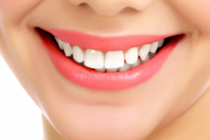 foto de sorriso com clareamento dental realizado na clinica sim