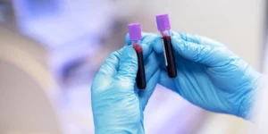 Frascos de coleta de sangue com foco no HCM, para análises laboratoriais para diagnósticos médicos.